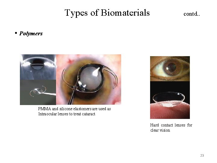 Types of Biomaterials contd. . • Polymers PMMA and silicone elastomers are used as