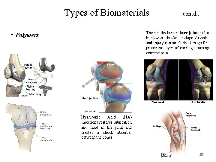 Types of Biomaterials • Polymers contd. . The healthy human knee joint is also