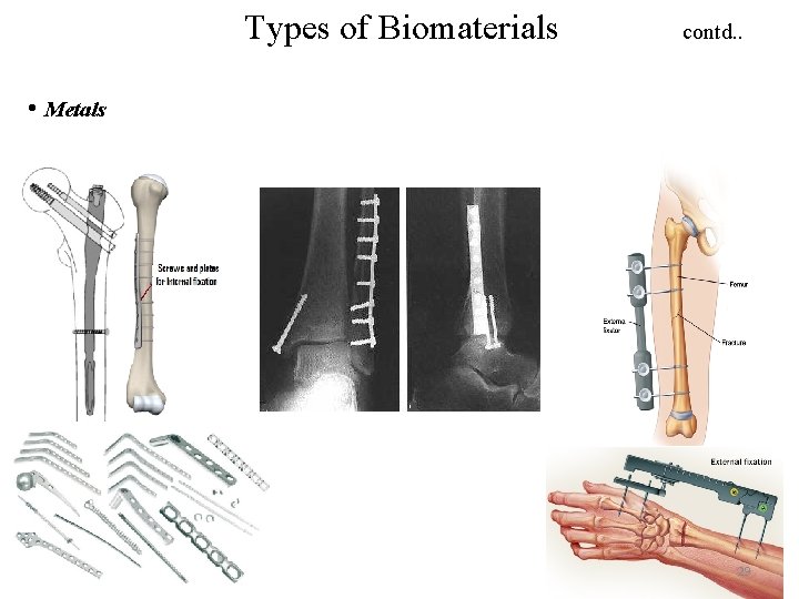 Types of Biomaterials contd. . • Metals 29 