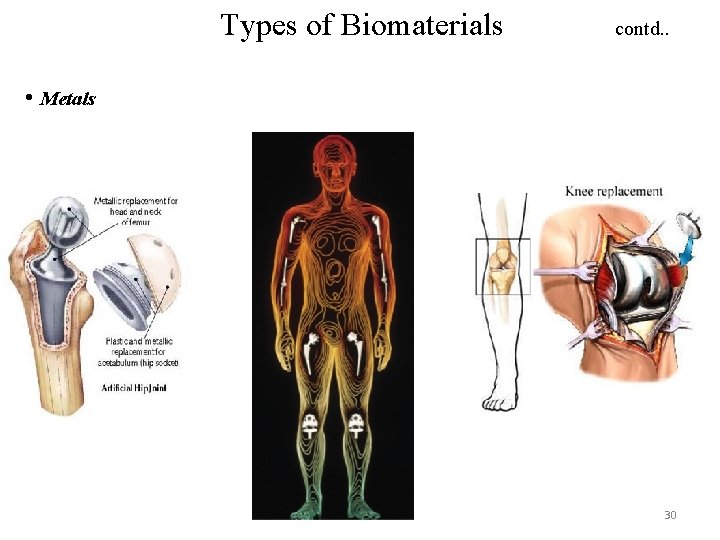 Types of Biomaterials contd. . • Metals 30 