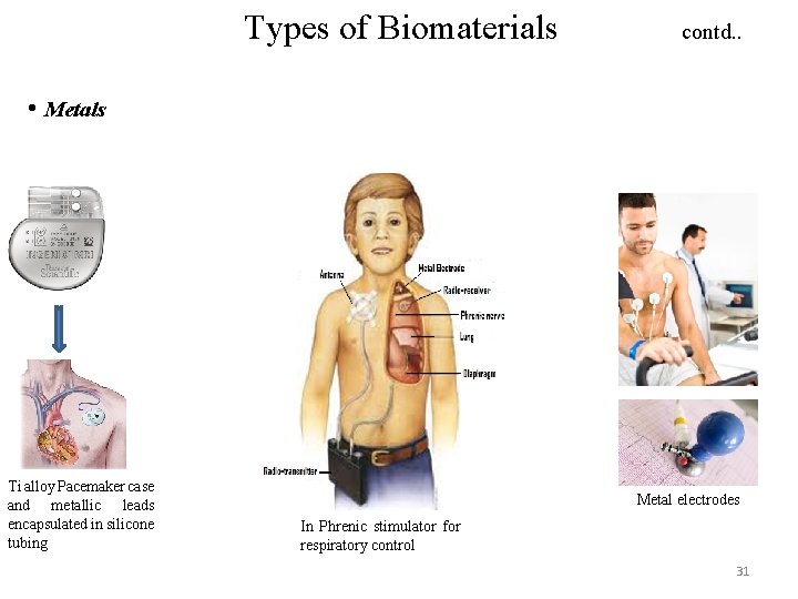 Types of Biomaterials contd. . • Metals Ti alloy Pacemaker case and metallic leads