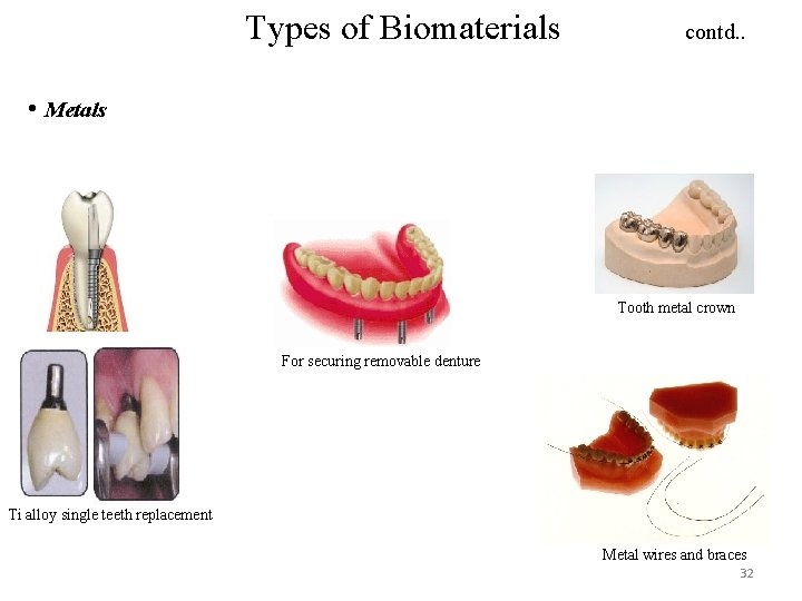 Types of Biomaterials contd. . • Metals Tooth metal crown For securing removable denture