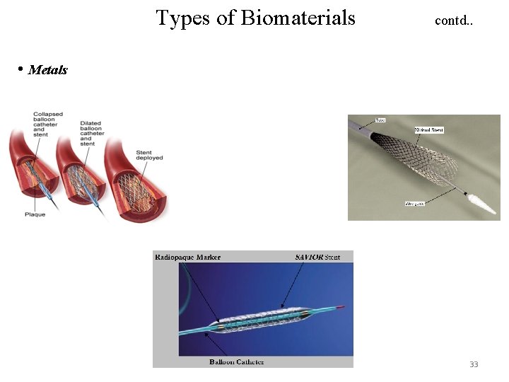 Types of Biomaterials contd. . • Metals 33 
