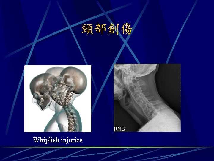 頸部創傷 Whiplish injuries 