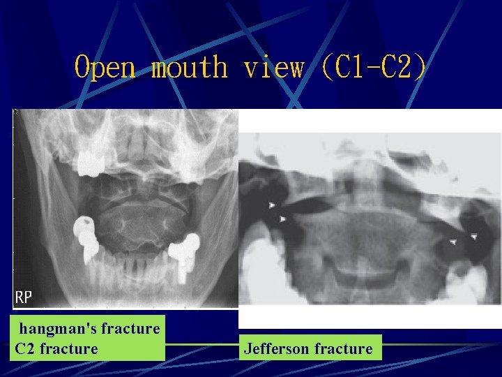 Open mouth view (C 1 -C 2) hangman's fracture C 2 fracture Jefferson fracture