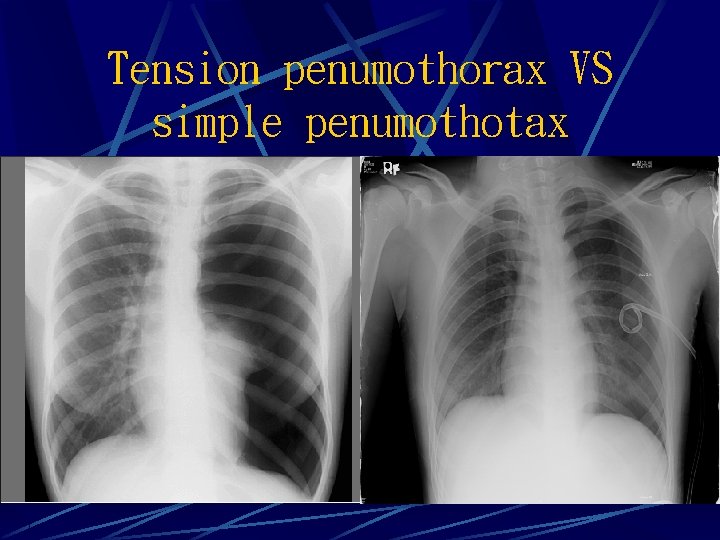 Tension penumothorax VS simple penumothotax 