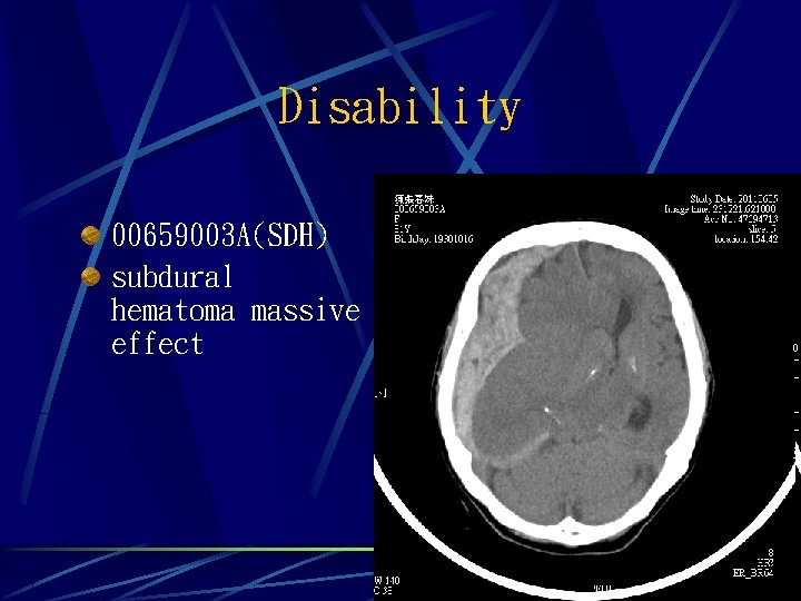 Disability 00659003 A(SDH) subdural hematoma massive effect 