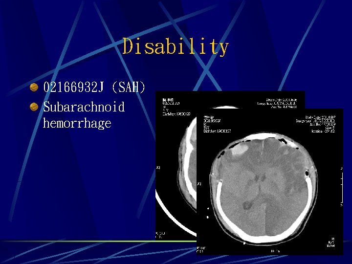 Disability 02166932 J (SAH) Subarachnoid hemorrhage 