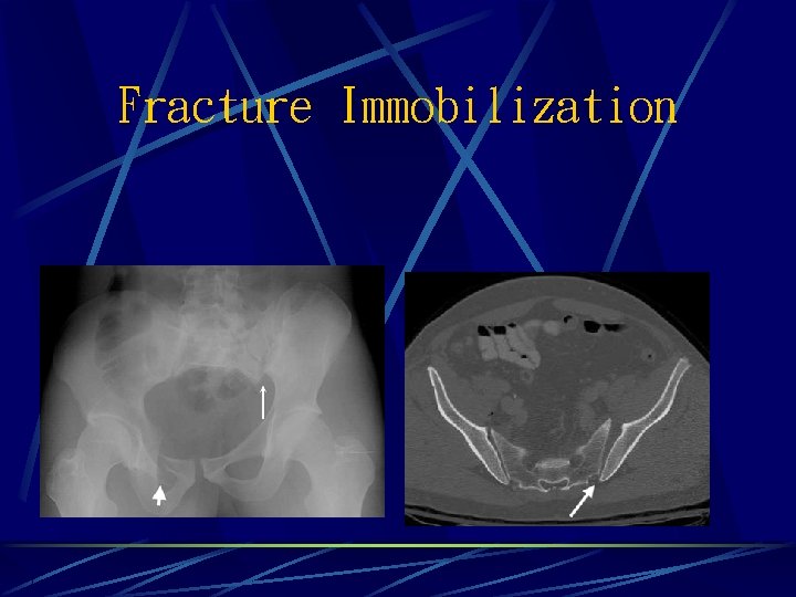 Fracture Immobilization 