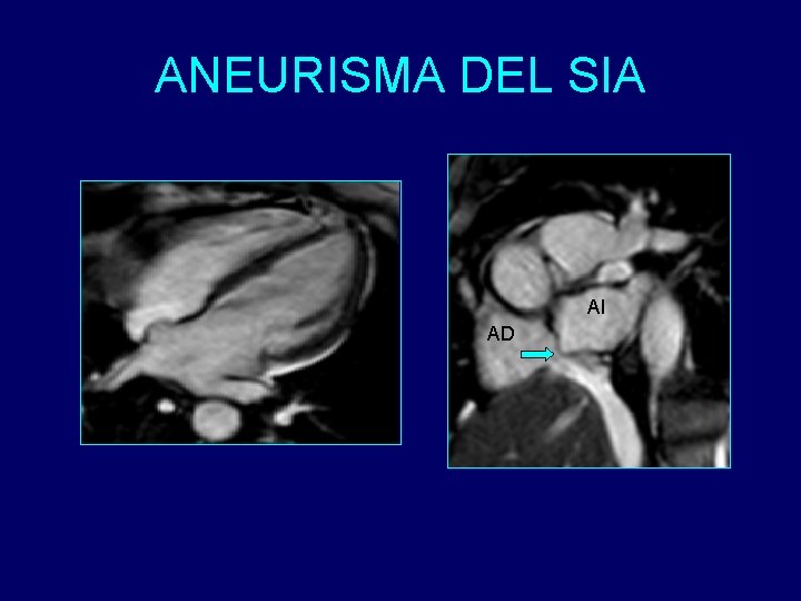 ANEURISMA DEL SIA AI AD 