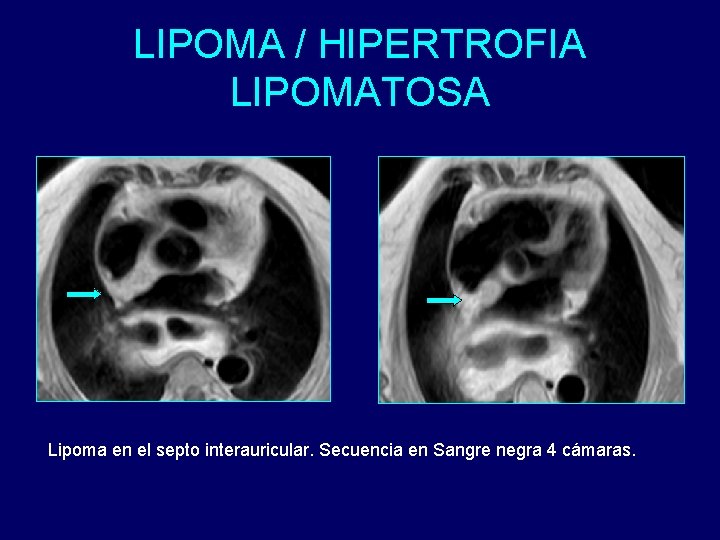 LIPOMA / HIPERTROFIA LIPOMATOSA Lipoma en el septo interauricular. Secuencia en Sangre negra 4