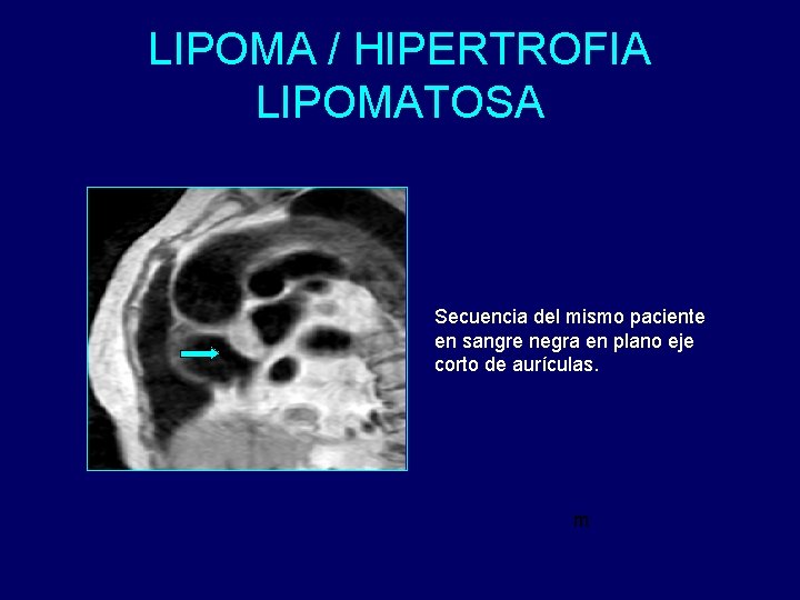 LIPOMA / HIPERTROFIA LIPOMATOSA Secuencia del mismo paciente en sangre negra en plano eje