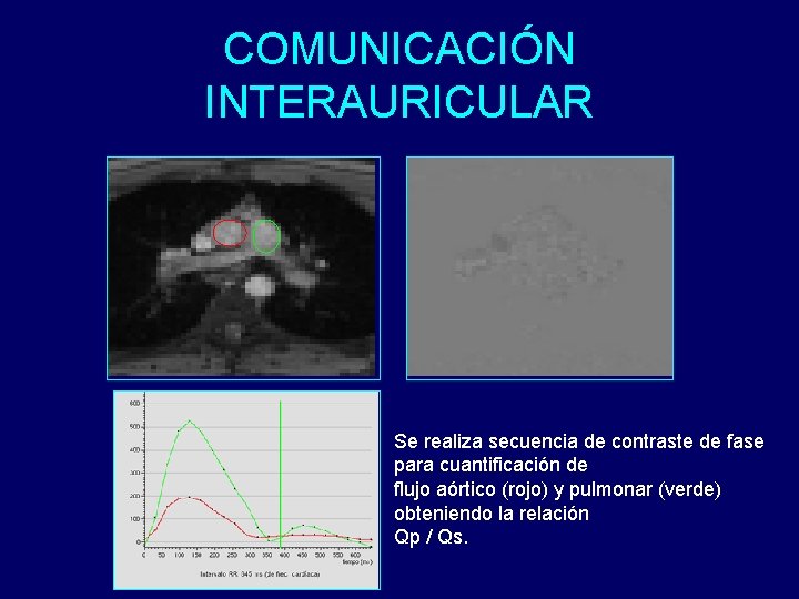 COMUNICACIÓN INTERAURICULAR Se realiza secuencia de contraste de fase para cuantificación de flujo aórtico