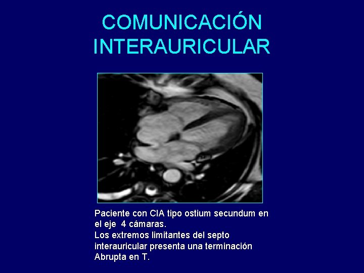 COMUNICACIÓN INTERAURICULAR Paciente con CIA tipo ostium secundum en el eje 4 cámaras. Los