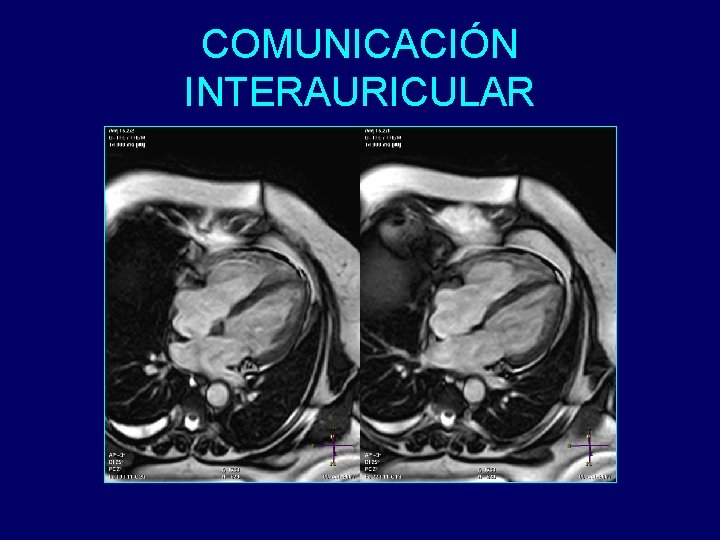 COMUNICACIÓN INTERAURICULAR 