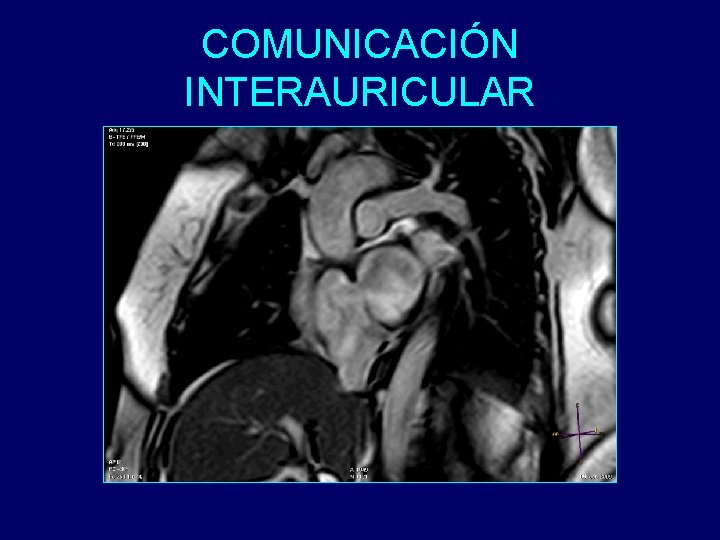 COMUNICACIÓN INTERAURICULAR 