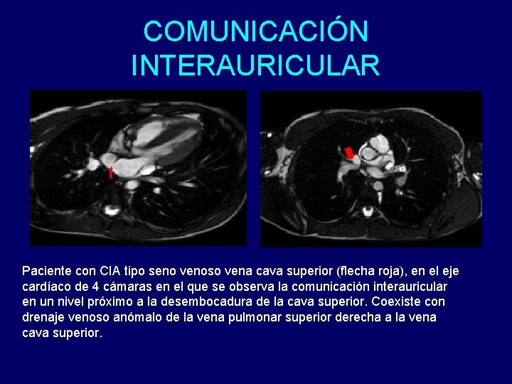 COMUNICACIÓN INTERAURICULAR Paciente con CIA tipo seno venoso vena cava superior (flecha roja), en
