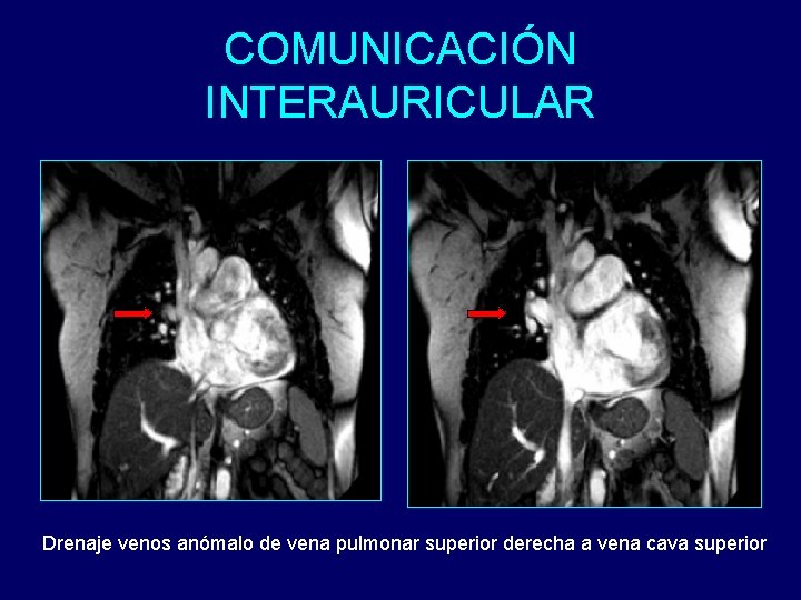 COMUNICACIÓN INTERAURICULAR Drenaje venos anómalo de vena pulmonar superior derecha a vena cava superior