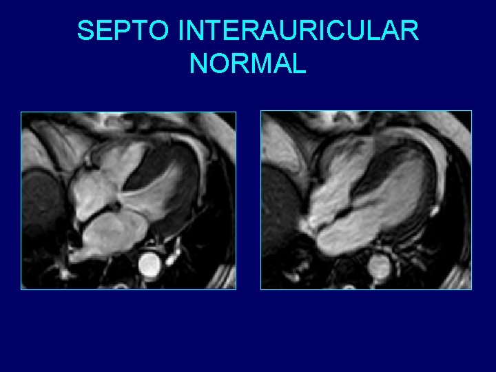 SEPTO INTERAURICULAR NORMAL 