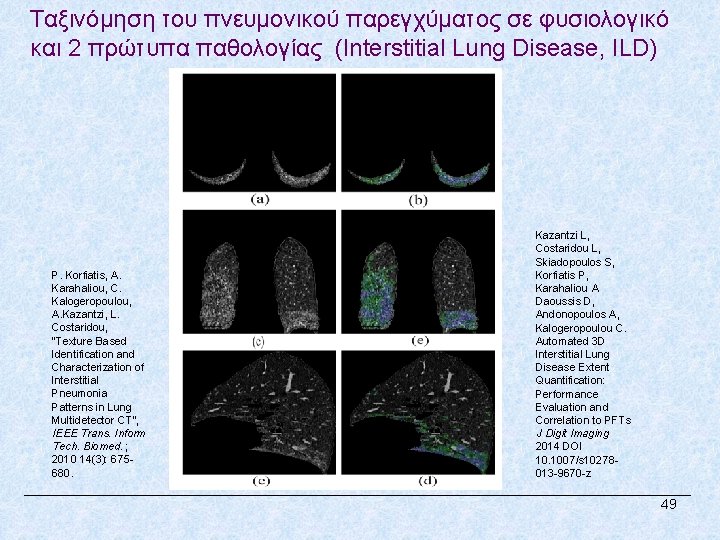 Ταξινόμηση του πνευμονικού παρεγχύματος σε φυσιολογικό και 2 πρώτυπα παθολογίας (Interstitial Lung Disease, ILD)