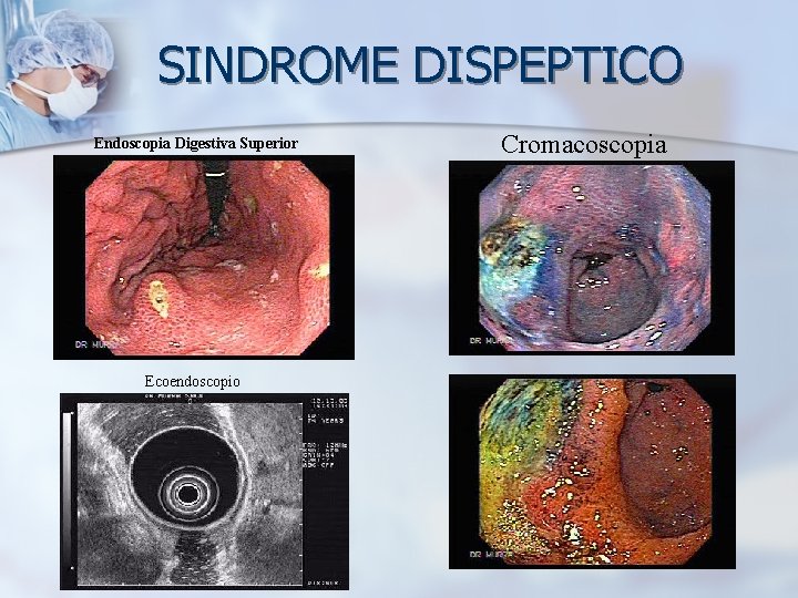 SINDROME DISPEPTICO Endoscopia Digestiva Superior Ecoendoscopio Cromacoscopia 