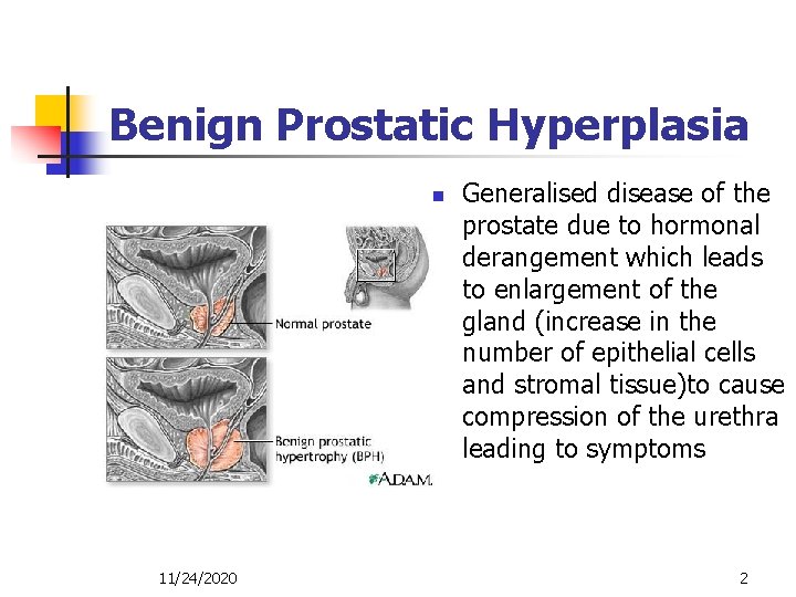 Benign Prostatic Hyperplasia n 11/24/2020 Generalised disease of the prostate due to hormonal derangement