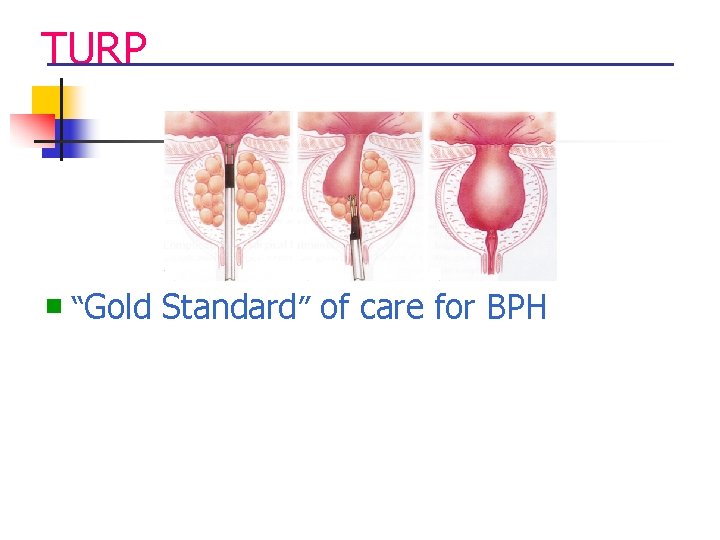 TURP n “Gold Standard” of care for BPH 