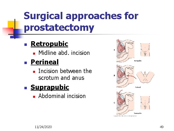 Surgical approaches for prostatectomy n Retropubic n n Perineal n n Midline abd. incision