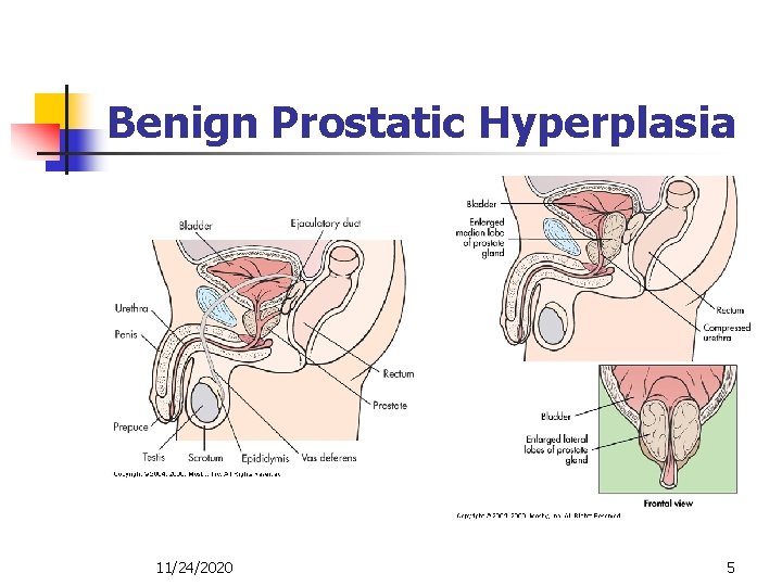 Benign Prostatic Hyperplasia 11/24/2020 5 