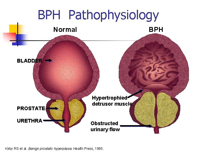 BPH Pathophysiology Normal BPH BLADDER PROSTATE URETHRA Hypertrophied detrusor muscle Obstructed urinary flow Kirby