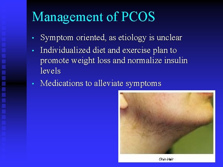 Management of PCOS • • • Symptom oriented, as etiology is unclear Individualized diet