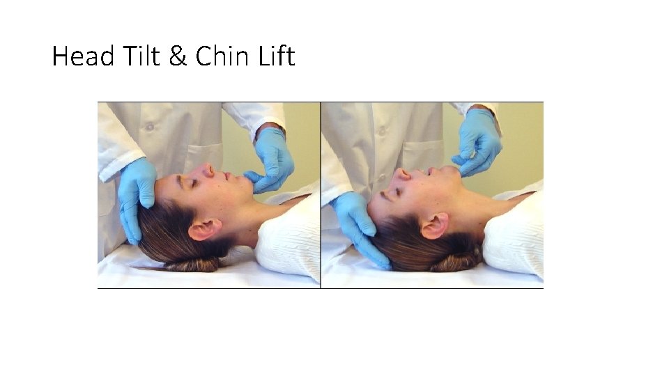 Head Tilt & Chin Lift 