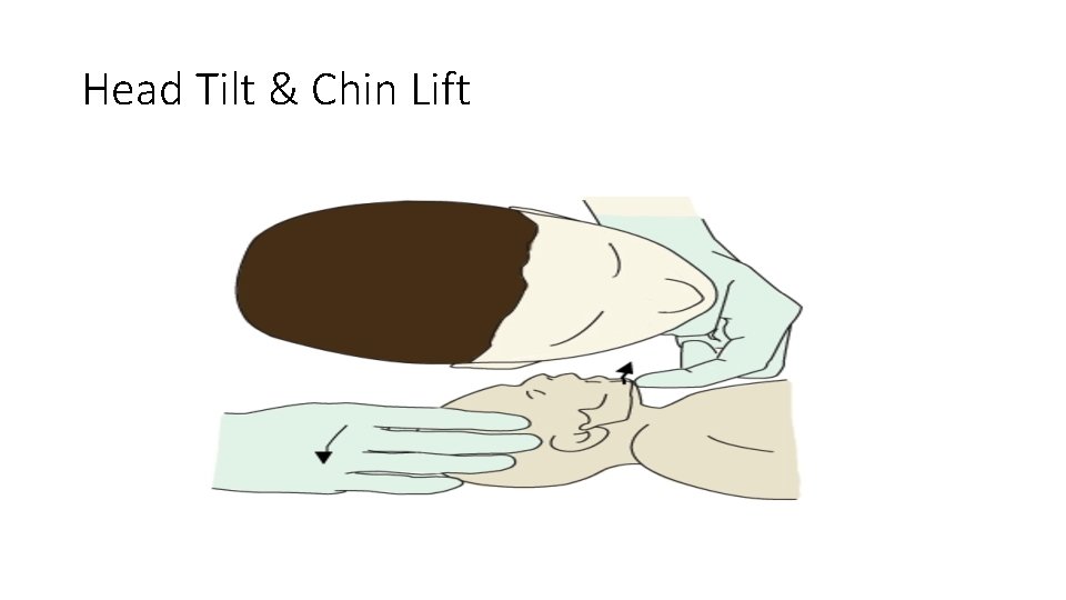 Head Tilt & Chin Lift 