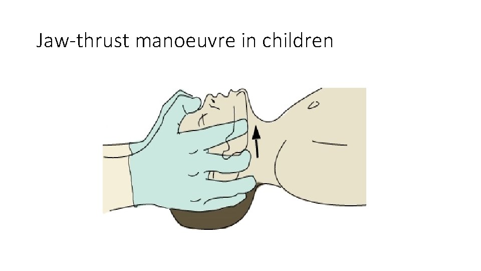 Jaw-thrust manoeuvre in children 