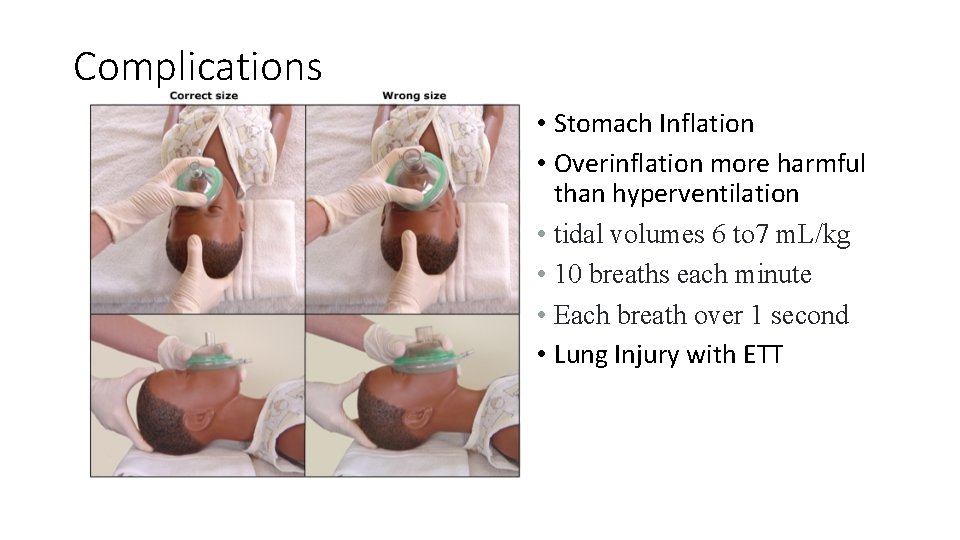 Complications • Stomach Inflation • Overinflation more harmful than hyperventilation • tidal volumes 6