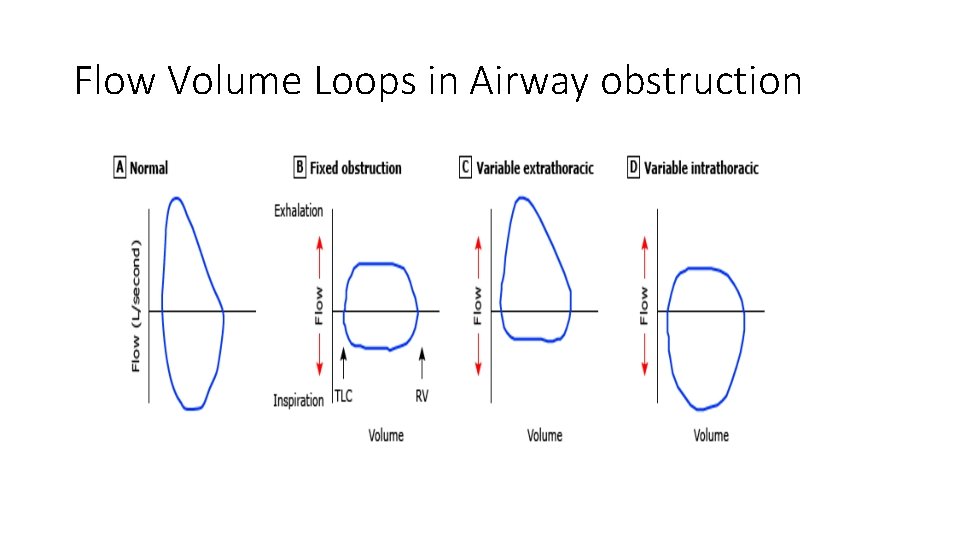 Flow Volume Loops in Airway obstruction 