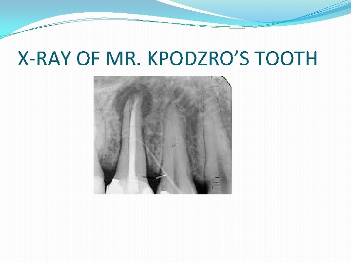 X-RAY OF MR. KPODZRO’S TOOTH 