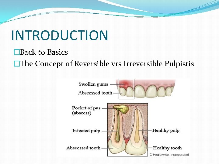 INTRODUCTION �Back to Basics �The Concept of Reversible vrs Irreversible Pulpistis 