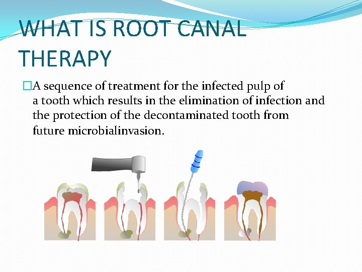 WHAT IS ROOT CANAL THERAPY �A sequence of treatment for the infected pulp of