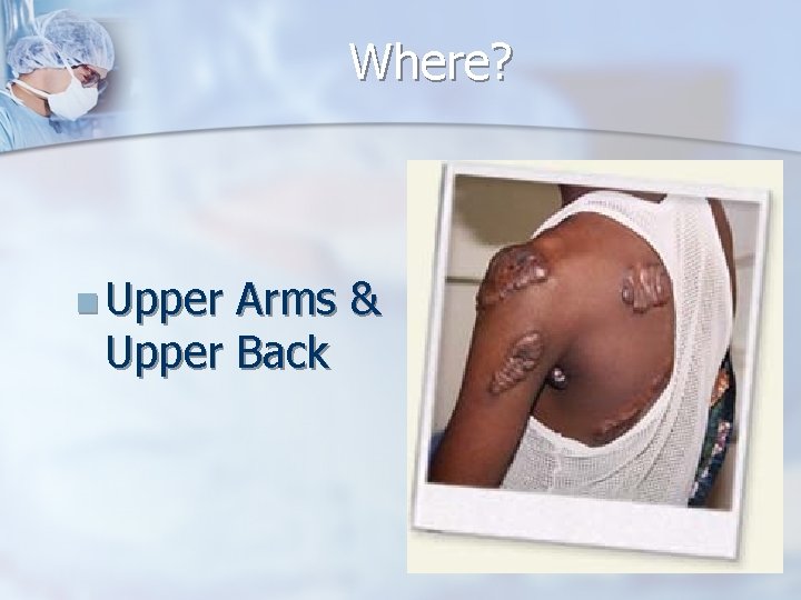 Where? n Upper Arms & Upper Back 