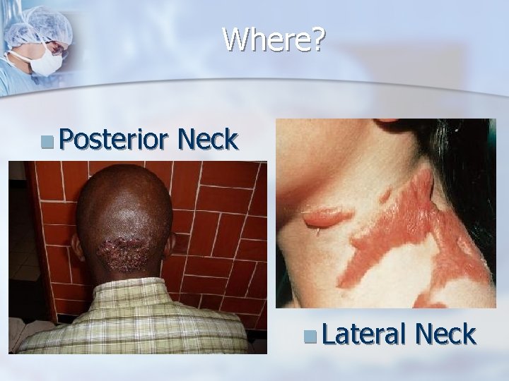 Where? n Posterior Neck n Lateral Neck 