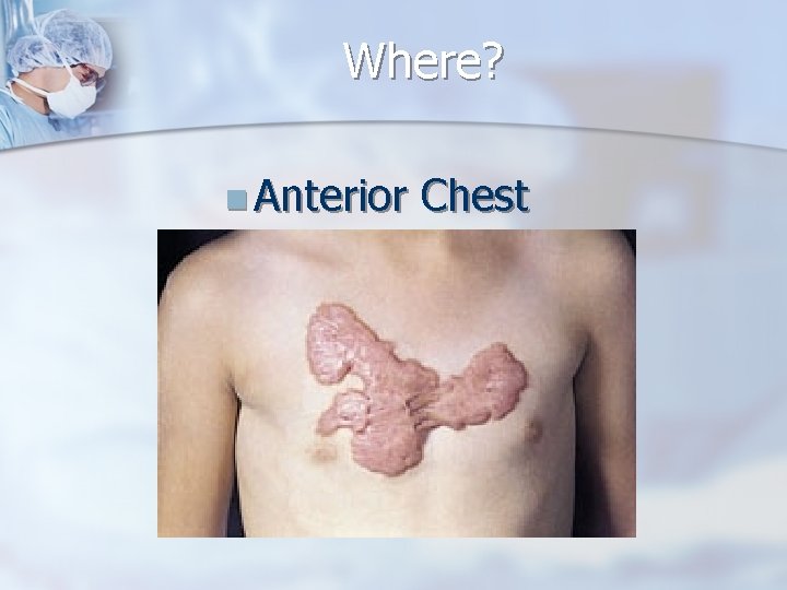 Where? n Anterior Chest 