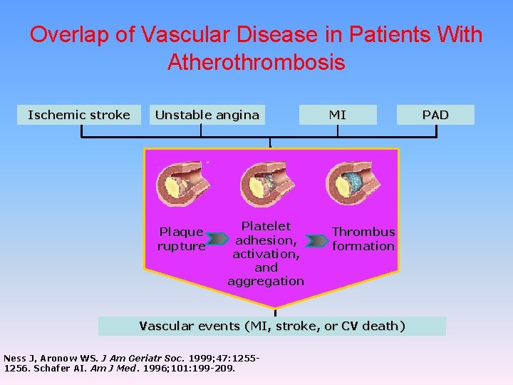 Overlap of Vascular Disease in Patients With Atherothrombosis Ischemic stroke Unstable angina Plaque rupture
