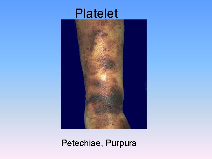 Platelet Petechiae, Purpura 