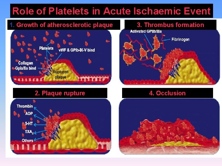 Role of Platelets in Acute Ischaemic Event 1. Growth of atherosclerotic plaque 2. Plaque