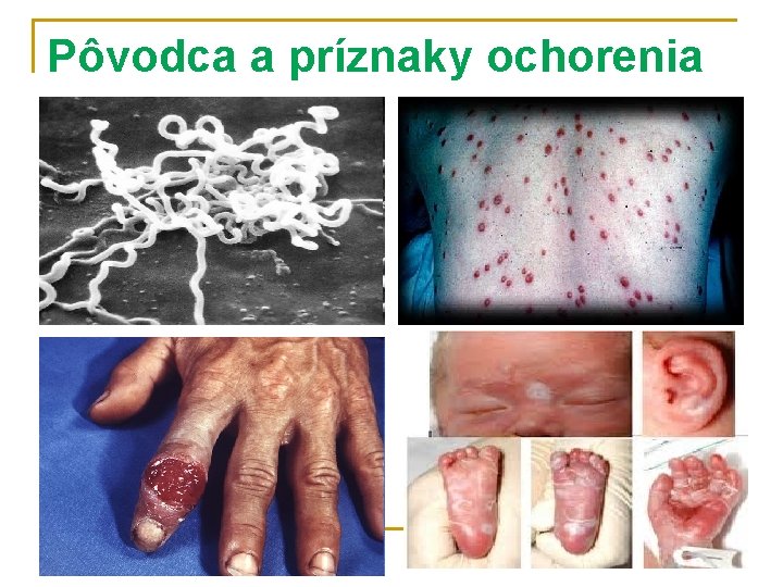 Pôvodca a príznaky ochorenia 