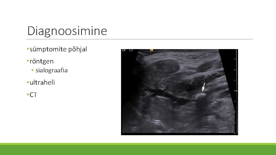 Diagnoosimine • sümptomite põhjal • röntgen • sialograafia • ultraheli • CT 