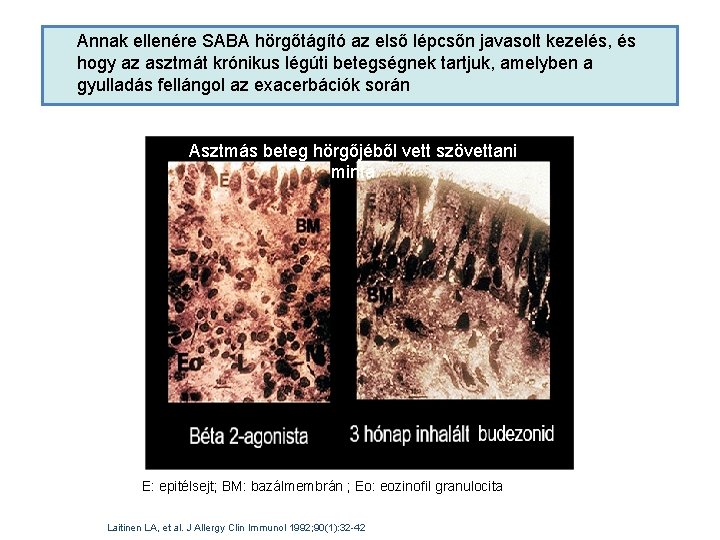 Annak ellenére SABA hörgőtágító az első lépcsőn javasolt kezelés, és hogy az asztmát krónikus