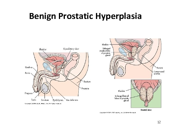 Benign Prostatic Hyperplasia 12 
