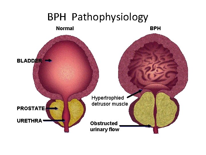 BPH Pathophysiology Normal BPH BLADDER PROSTATE URETHRA Hypertrophied detrusor muscle Obstructed urinary flow 